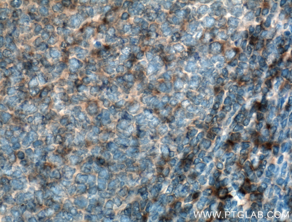 IHC staining of human tonsillitis using 27411-1-AP