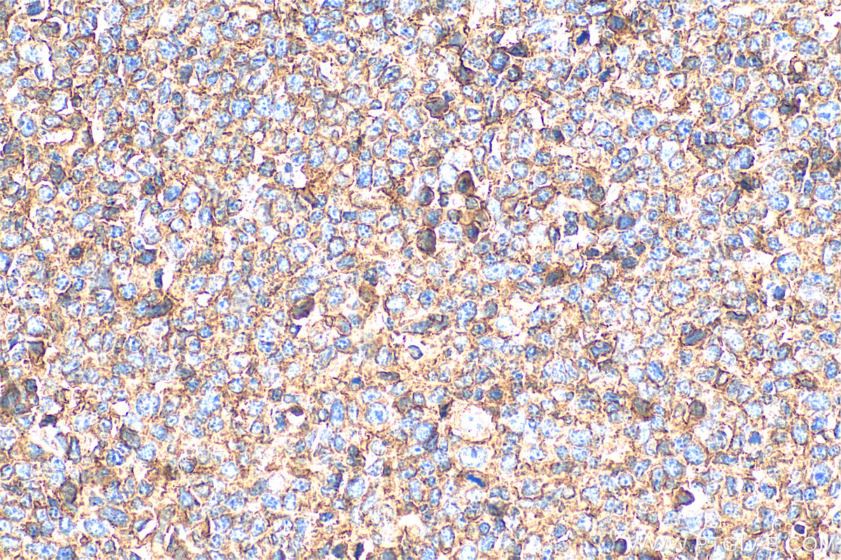 IHC staining of human tonsillitis using 27411-1-AP