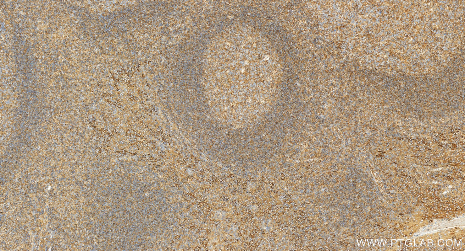 IHC staining of human tonsillitis using 27411-1-AP