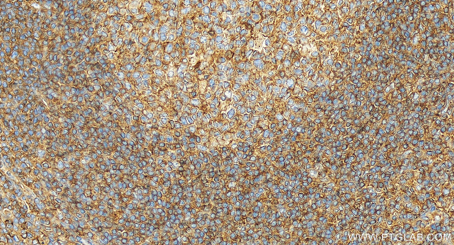 IHC staining of human tonsillitis using 27411-1-AP