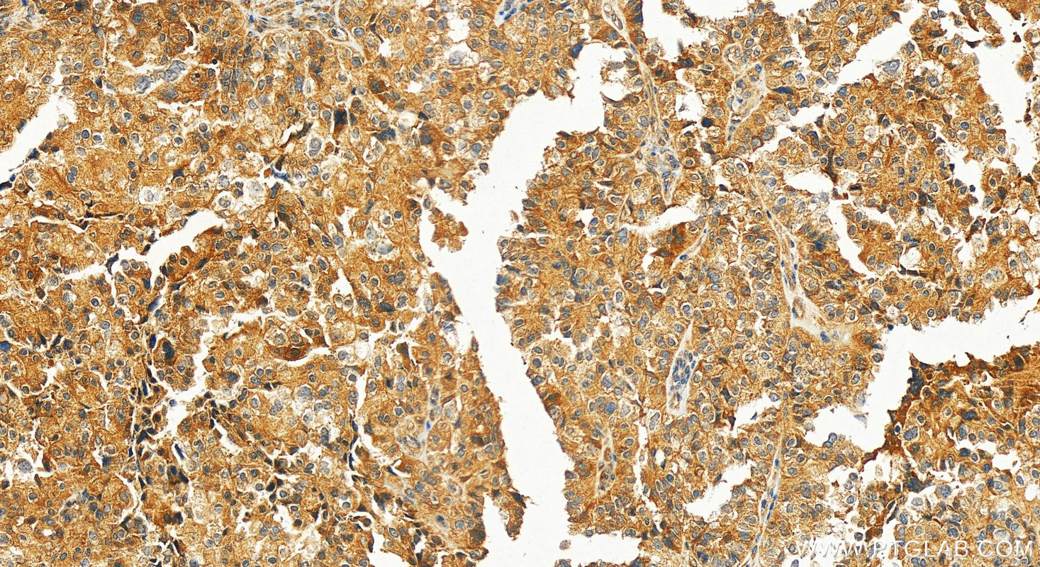 Immunohistochemical analysis of paraffin-embedded human ovary cancer tissue slide using 14046-1-AP (HLCS antibody) at dilution of 1:500 (under 20x lens). Heat mediated antigen retrieval with Tris-EDTA buffer (pH 9.0). IHC staining of human ovary cancer using 14046-1-AP