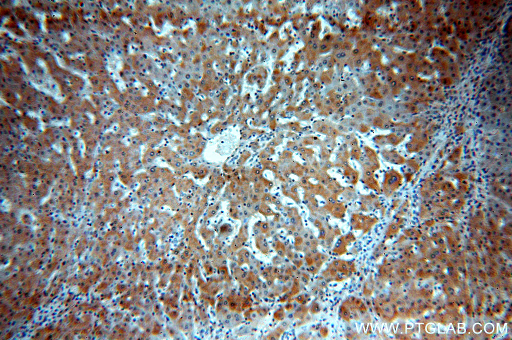 IHC staining of human hepatocirrhosis using 20416-1-AP