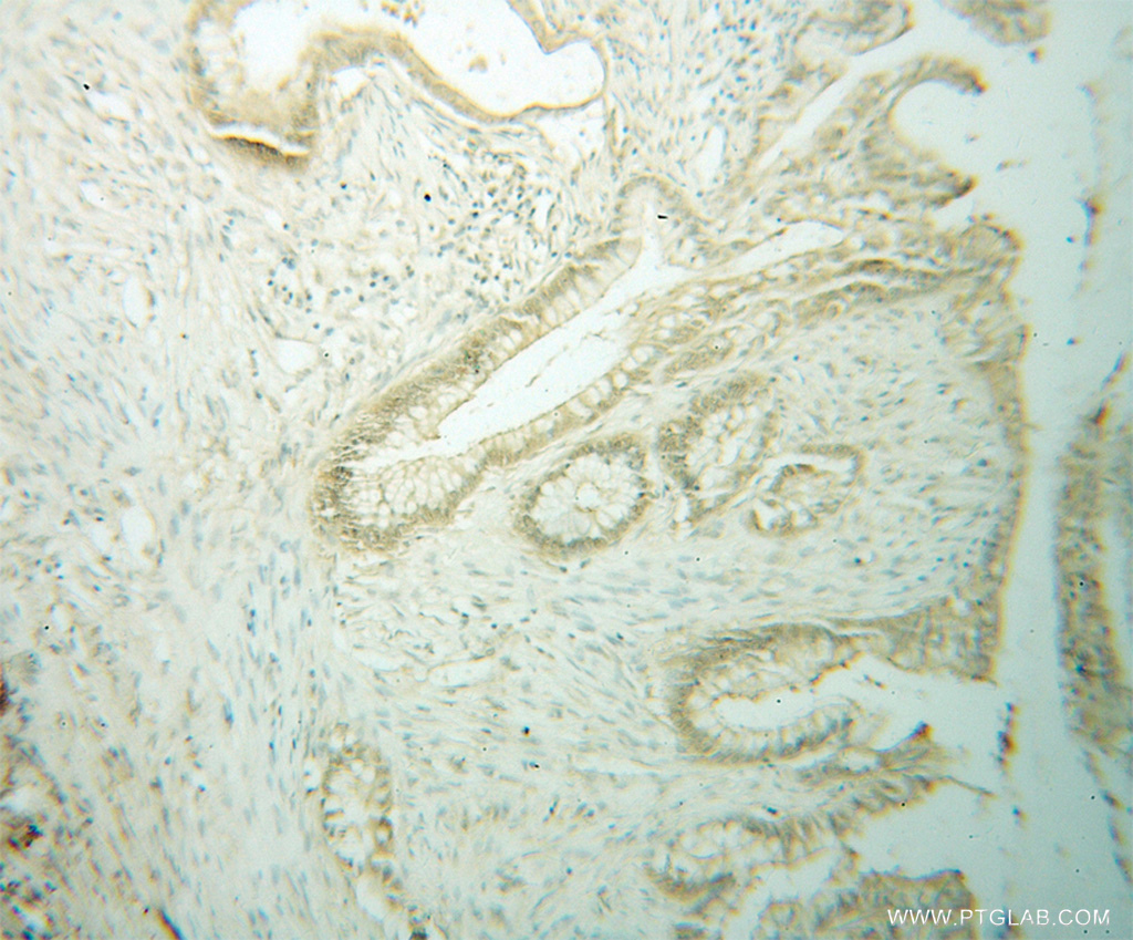 IHC staining of human colon cancer using 14582-1-AP