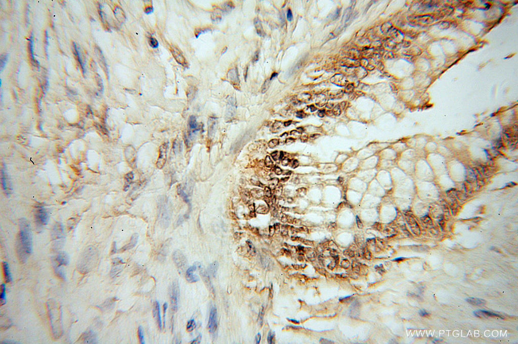 IHC staining of human colon cancer using 14582-1-AP
