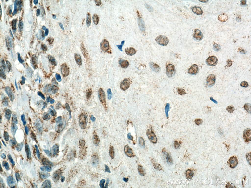 IHC staining of human skin cancer using 67354-1-Ig (same clone as 67354-1-PBS)