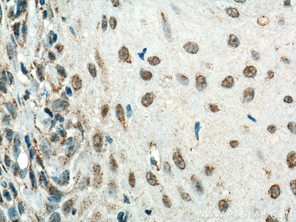 IHC staining of human skin cancer using 67354-1-Ig