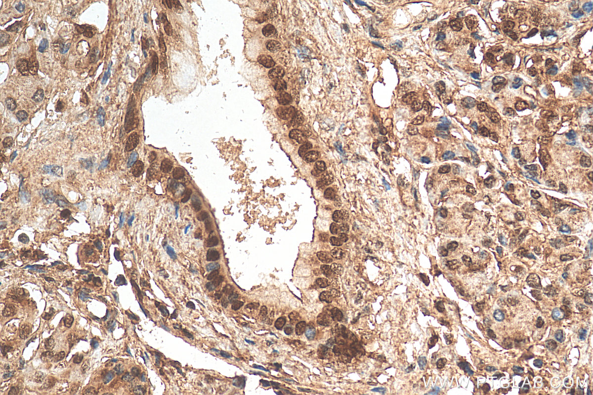 IHC staining of human pancreas cancer using 29895-1-AP