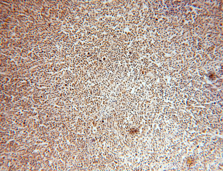IHC staining of human lymphoma using 15605-1-AP