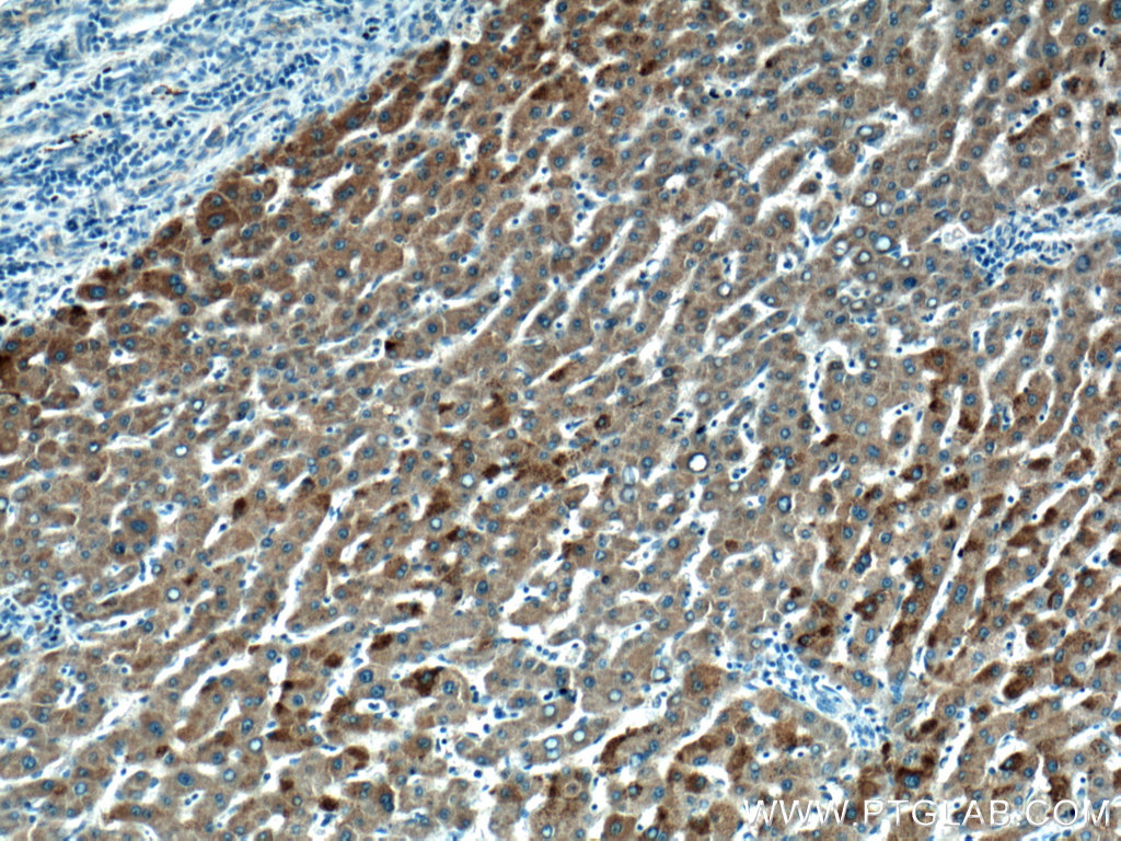 IHC staining of human liver cancer using 17206-1-AP