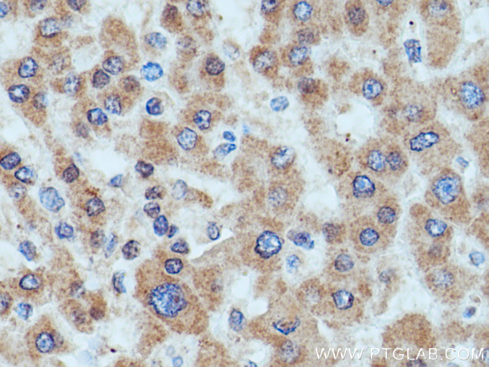 IHC staining of human liver cancer using 13533-1-AP