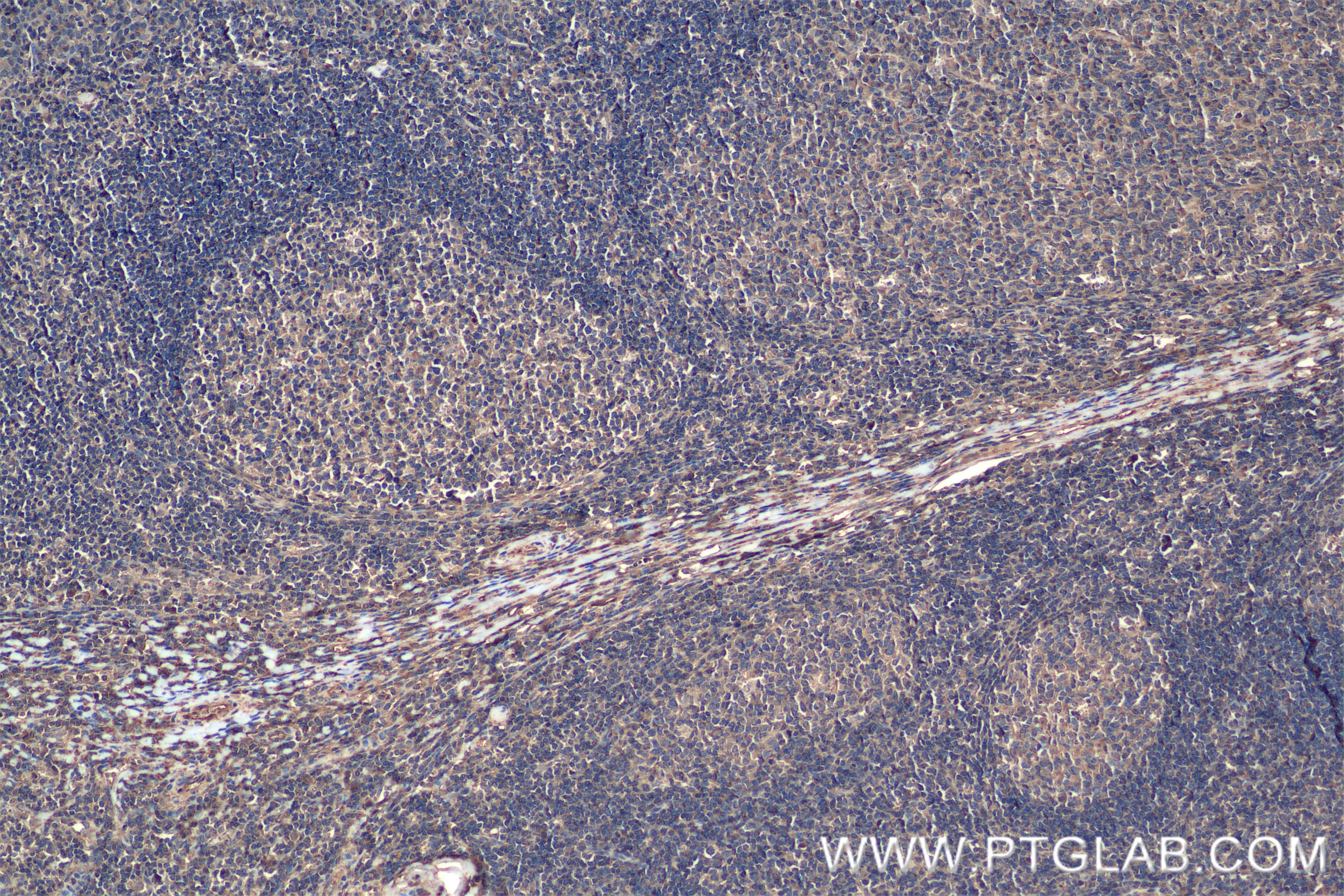 IHC staining of human tonsillitis using 85094-1-RR (same clone as 85094-1-PBS)
