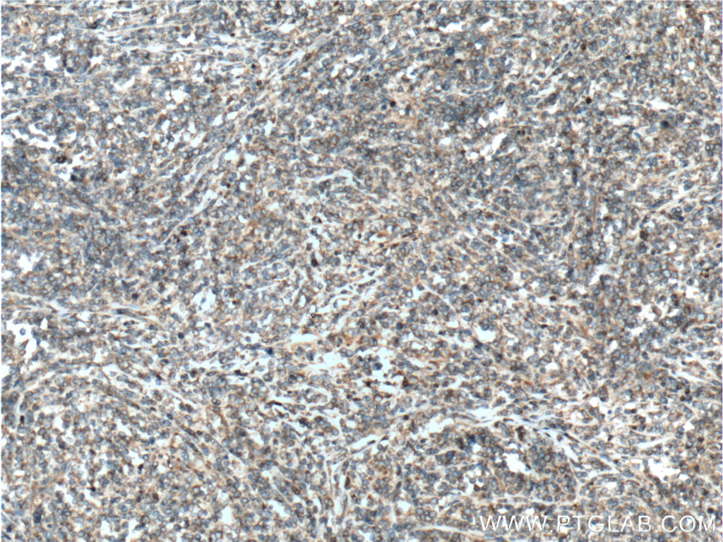 IHC staining of human lymphoma using 14817-1-AP