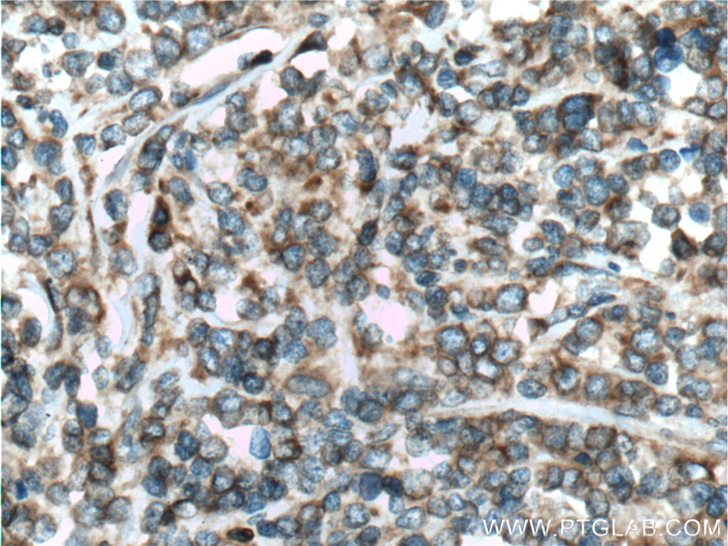 IHC staining of human lymphoma using 14817-1-AP