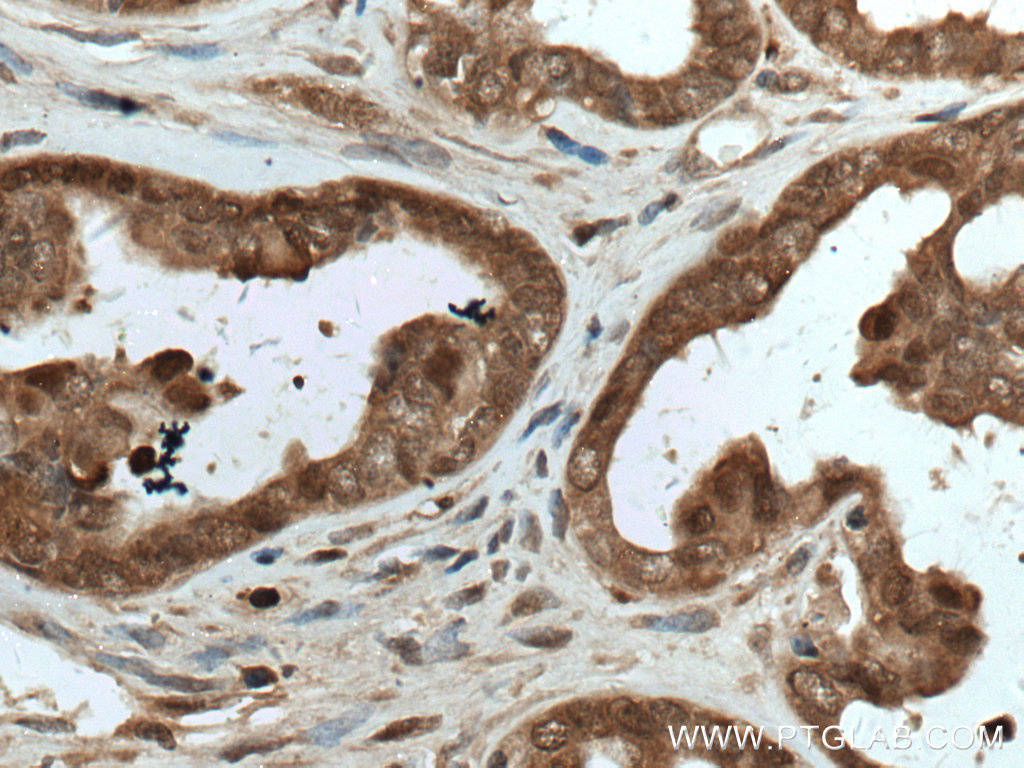 IHC staining of human ovary tumor using 14914-1-AP