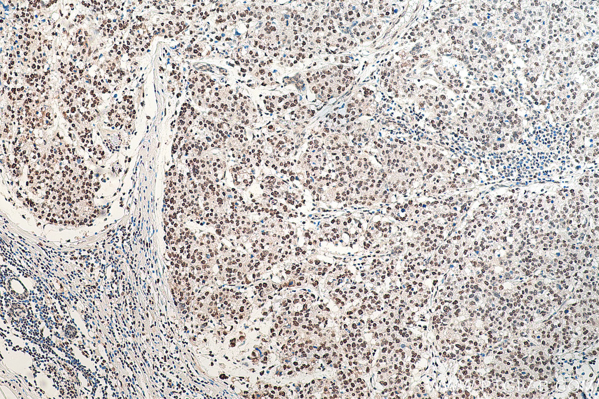 IHC staining of human breast cancer using 11176-1-AP