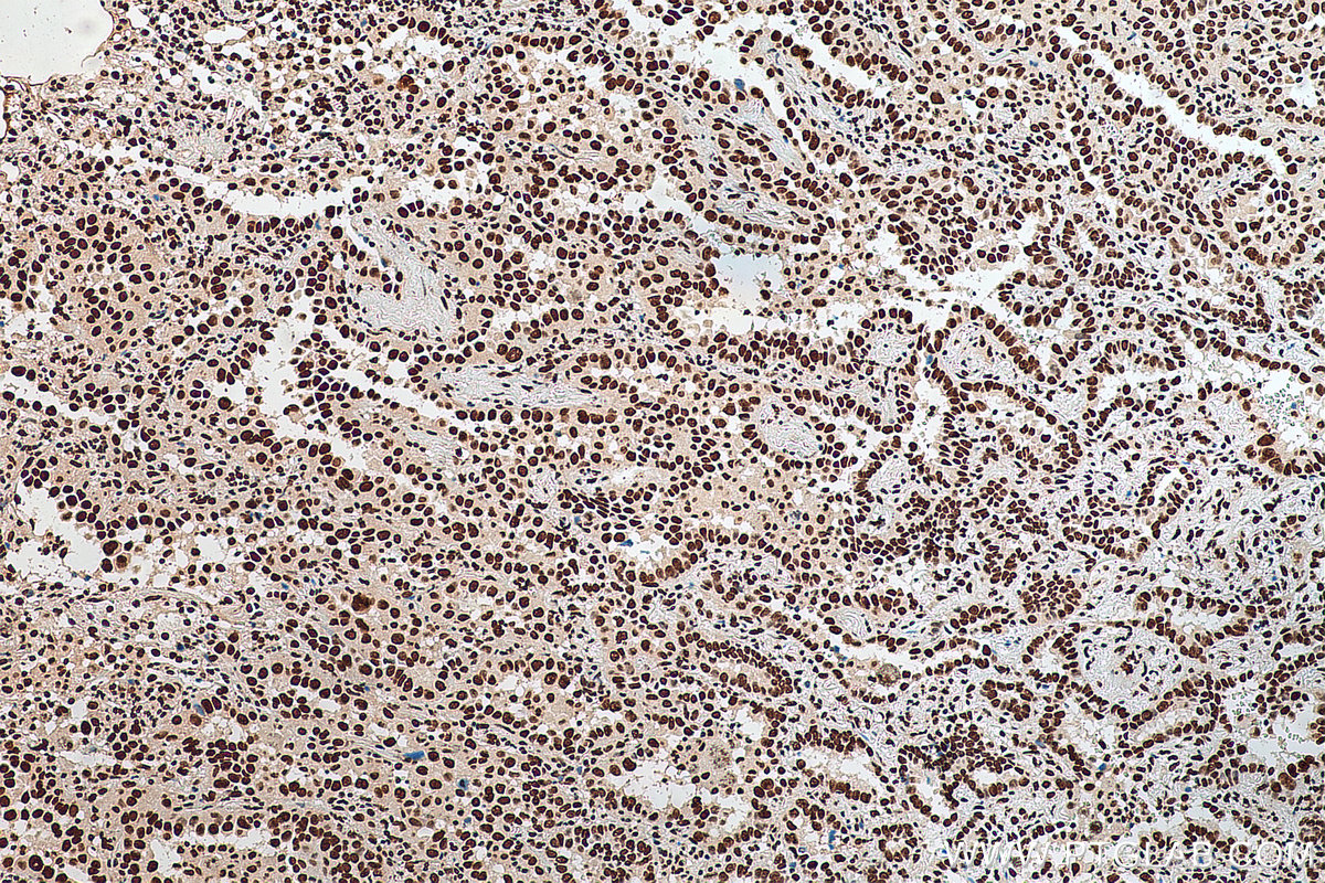 IHC staining of human lung cancer using 11176-1-AP