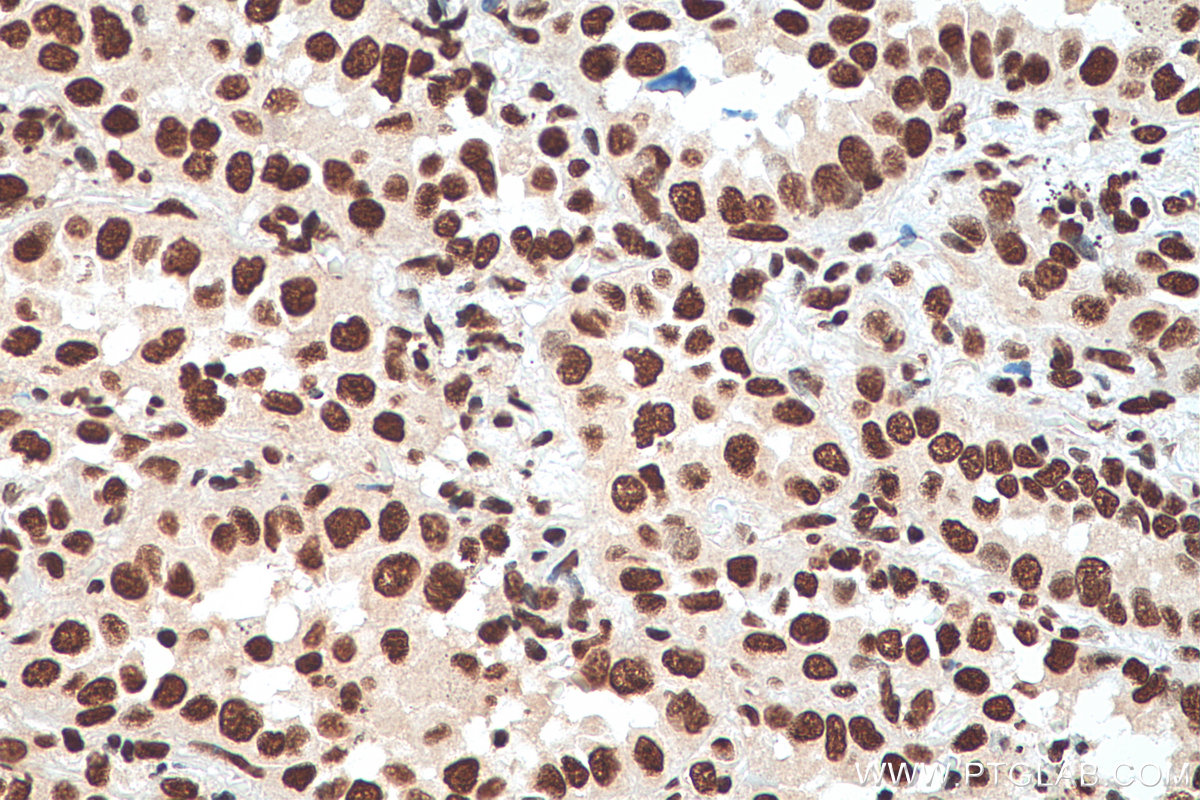 IHC staining of human lung cancer using 11176-1-AP