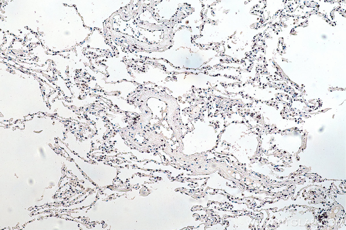 IHC staining of human lung cancer using 67844-1-Ig