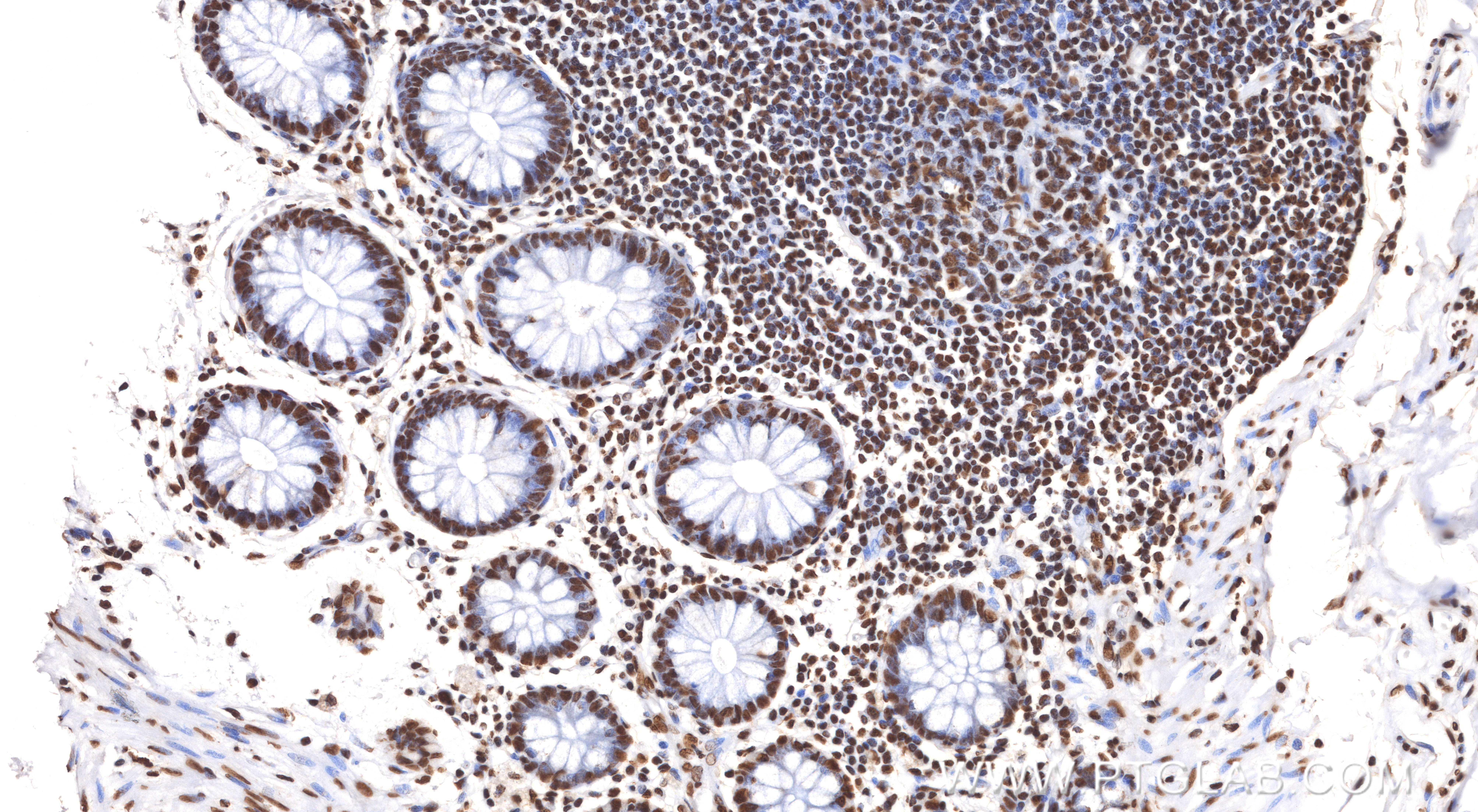 IHC staining of human colon using 86713-1-MR (same clone as 86713-1-PBS) IHC staining of human colon using 86713-1-MR (same clone as 86713-1-PBS)
