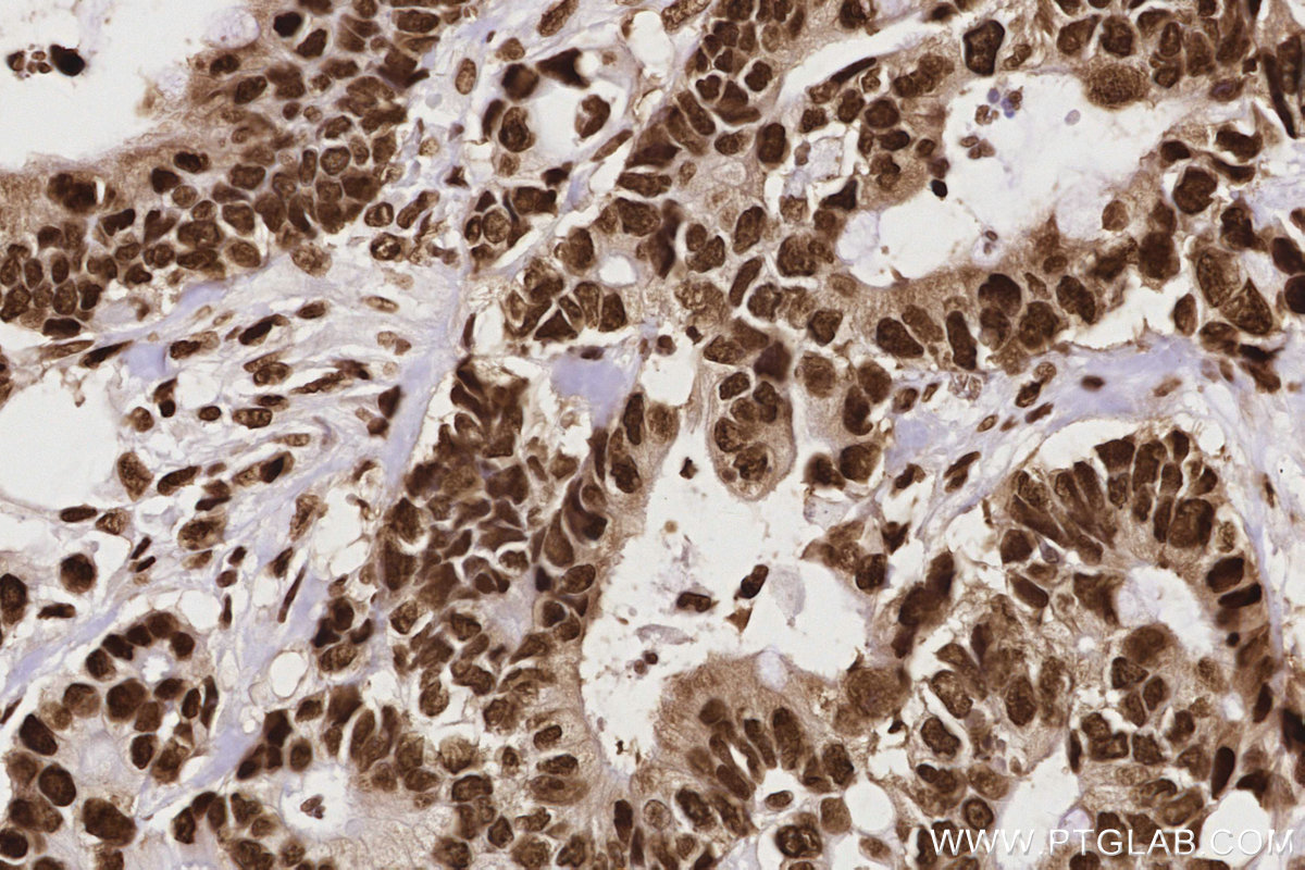 IHC staining of human rectal cancer using 84207-1-RR