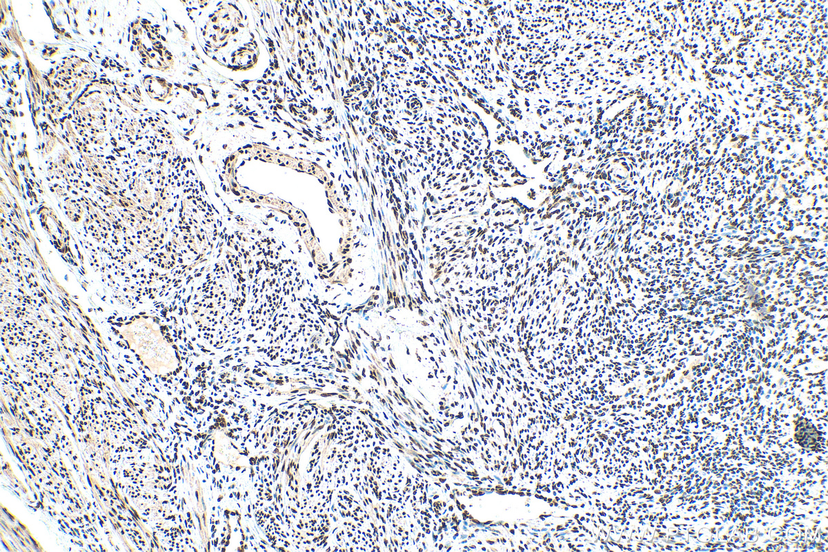IHC staining of human cervical cancer using 12770-1-AP