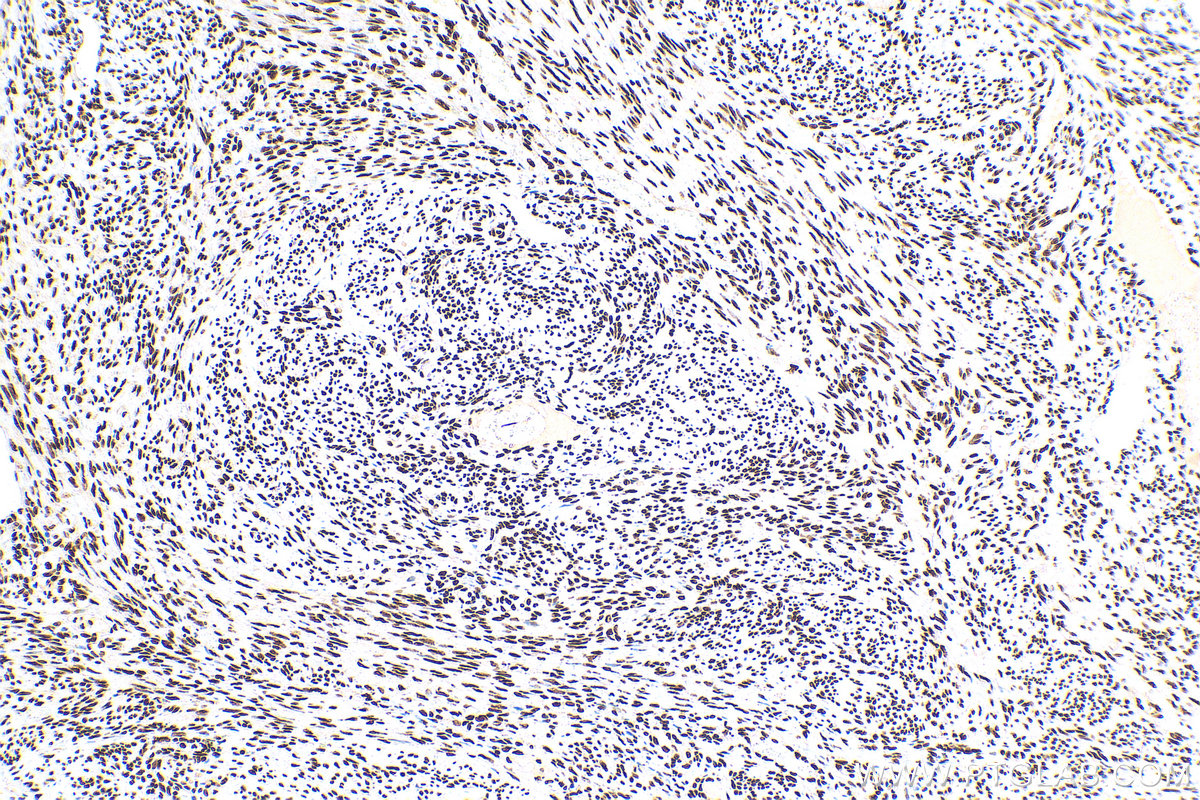 IHC staining of human cervical cancer using 68236-1-Ig