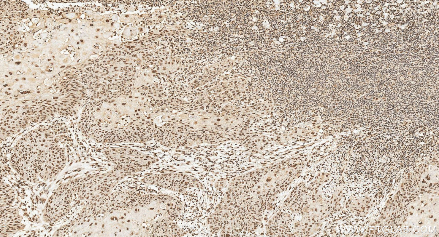IHC staining of human cervical cancer using 14774-1-AP IHC staining of human cervical cancer using 14774-1-AP