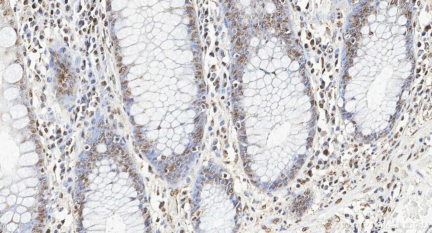 IHC staining of human colon using 14774-1-AP IHC staining of human colon using 14774-1-AP