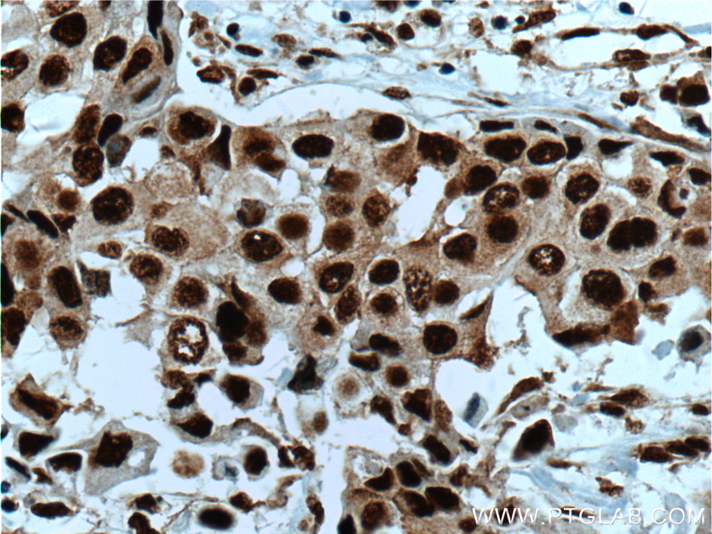 IHC staining of human breast cancer using 11426-1-AP