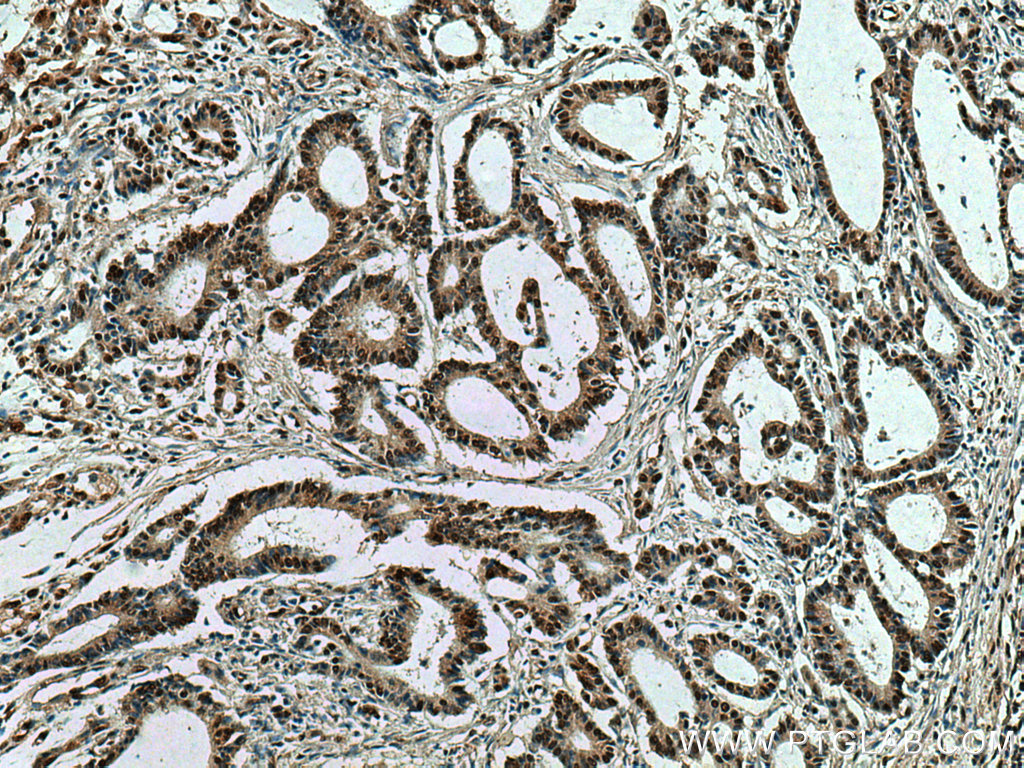 IHC staining of human colon cancer using 67708-1-Ig (same clone as 67708-1-PBS)
