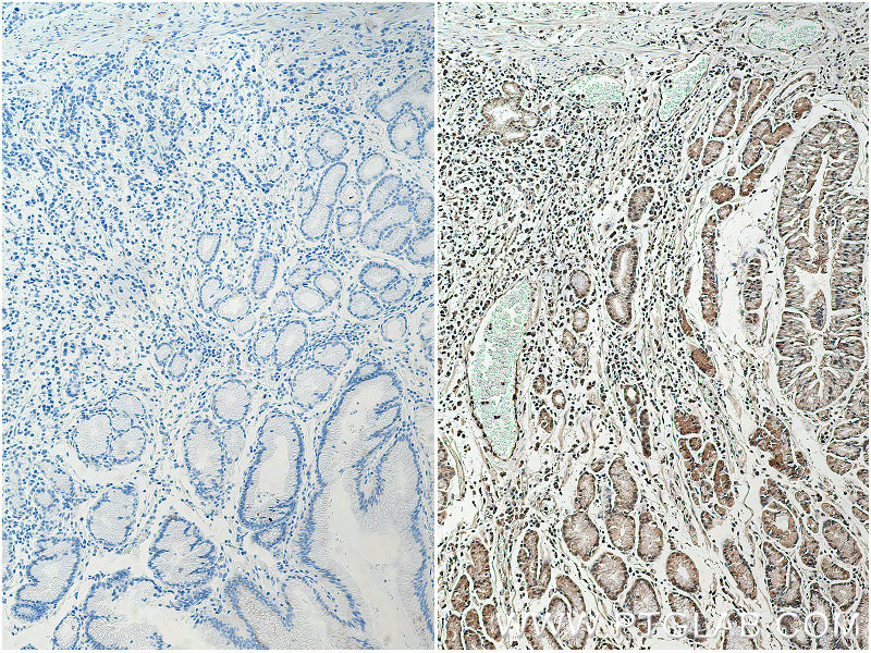 IHC staining of human stomach cancer using 18354-1-AP