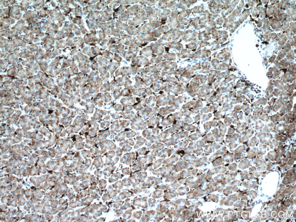 IHC staining of human liver cancer using 66743-1-Ig (same clone as 66743-1-PBS)