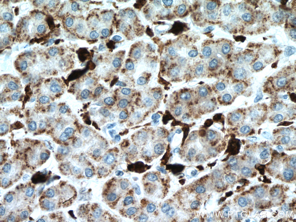 IHC staining of human liver cancer using 66743-1-Ig (same clone as 66743-1-PBS)