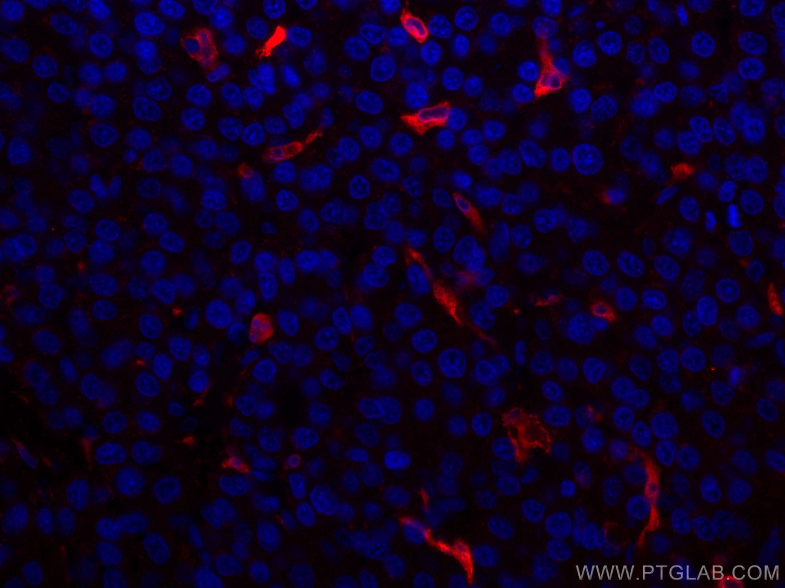 IF Staining of human liver cancer using CL594-10701