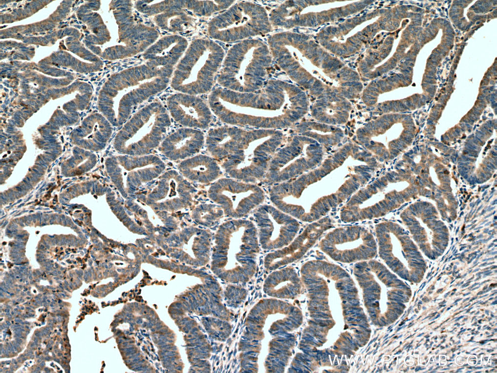 IHC staining of human endometrial cancer using 67377-1-Ig