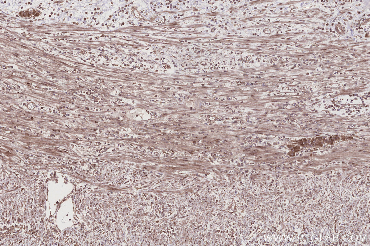 IHC staining of human appendicitis using 32110-1-AP IHC staining of human appendicitis using 32110-1-AP