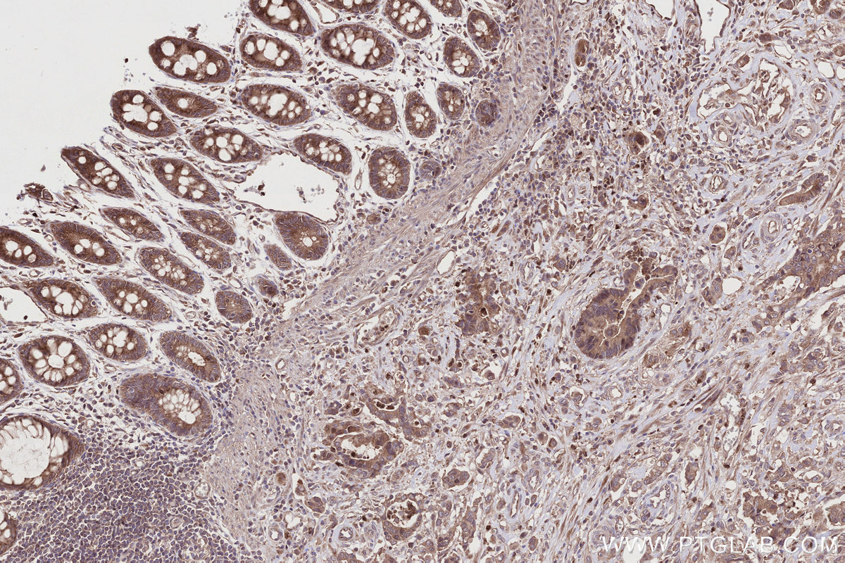 IHC staining of human rectal cancer using 32110-1-AP IHC staining of human rectal cancer using 32110-1-AP