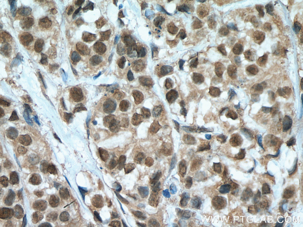 IHC staining of human breast cancer using 67091-1-Ig
