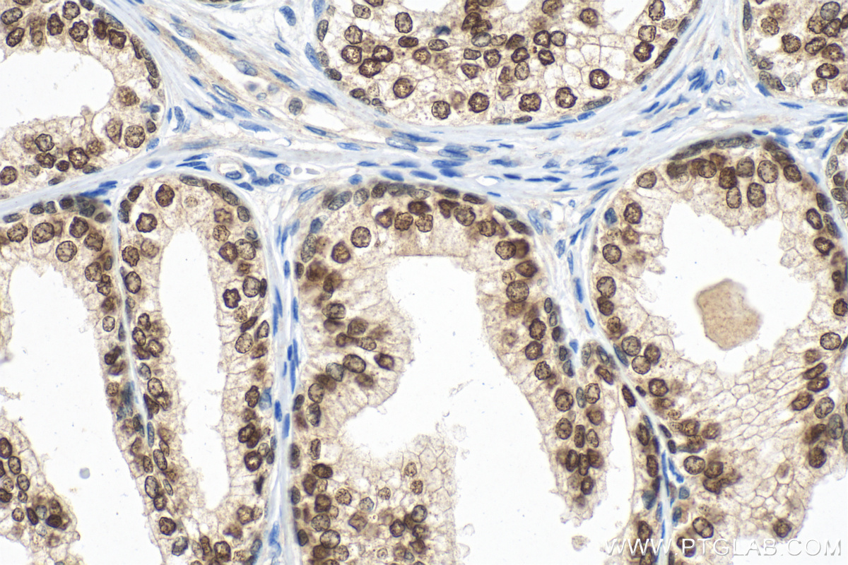 IHC staining of human prostate cancer using 26384-1-AP