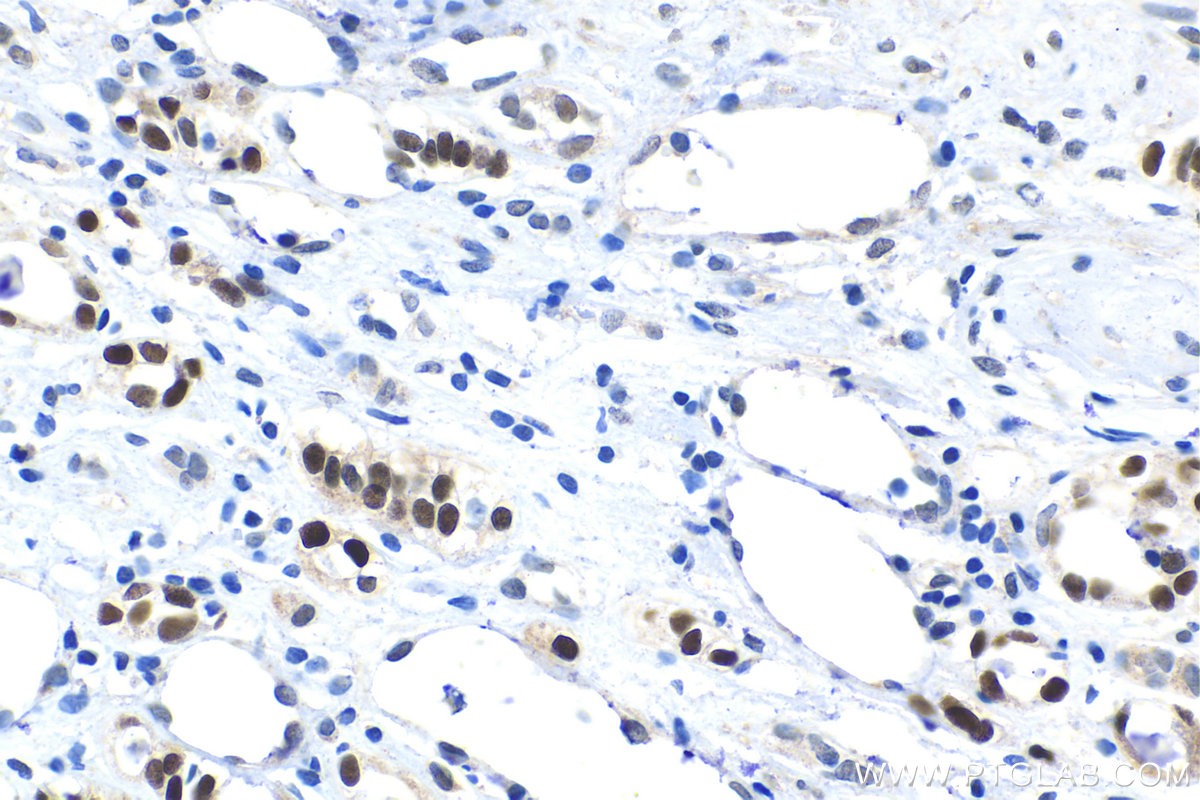 IHC staining of human renal cell carcinoma using 18588-1-AP (same clone as 18588-1-PBS)