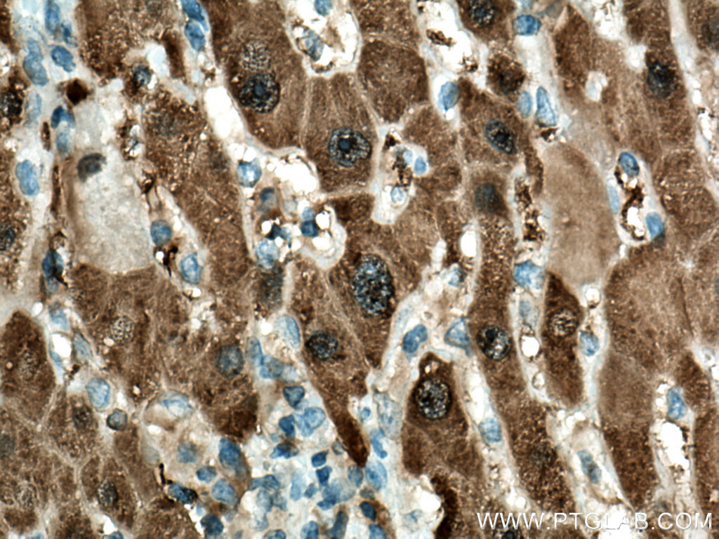 IHC staining of human liver cancer using 67552-1-Ig