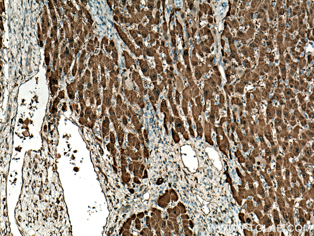 IHC staining of human liver cancer using 67552-1-Ig