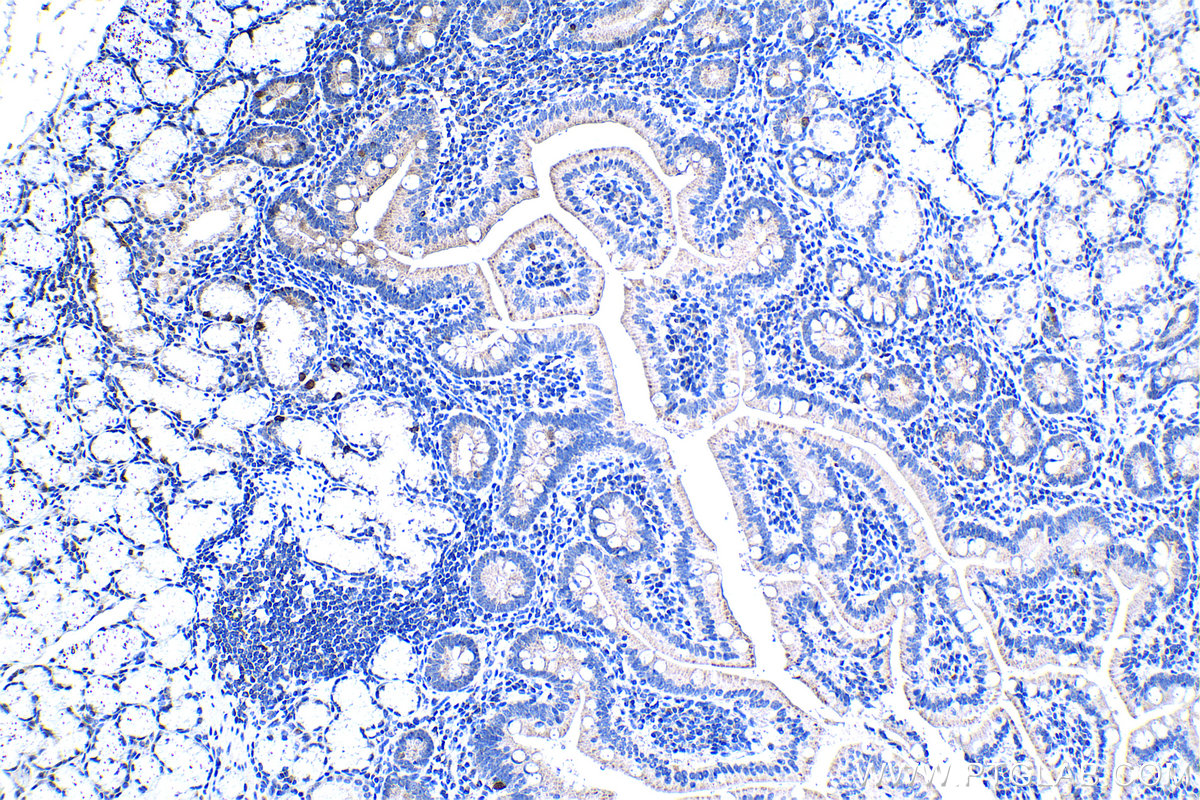 IHC staining of human stomach cancer using 20777-1-AP IHC staining of human stomach cancer using 20777-1-AP