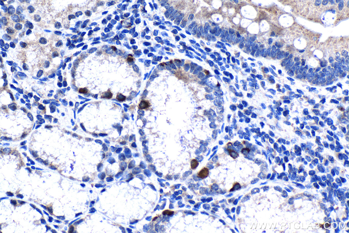 IHC staining of human stomach cancer using 20777-1-AP IHC staining of human stomach cancer using 20777-1-AP