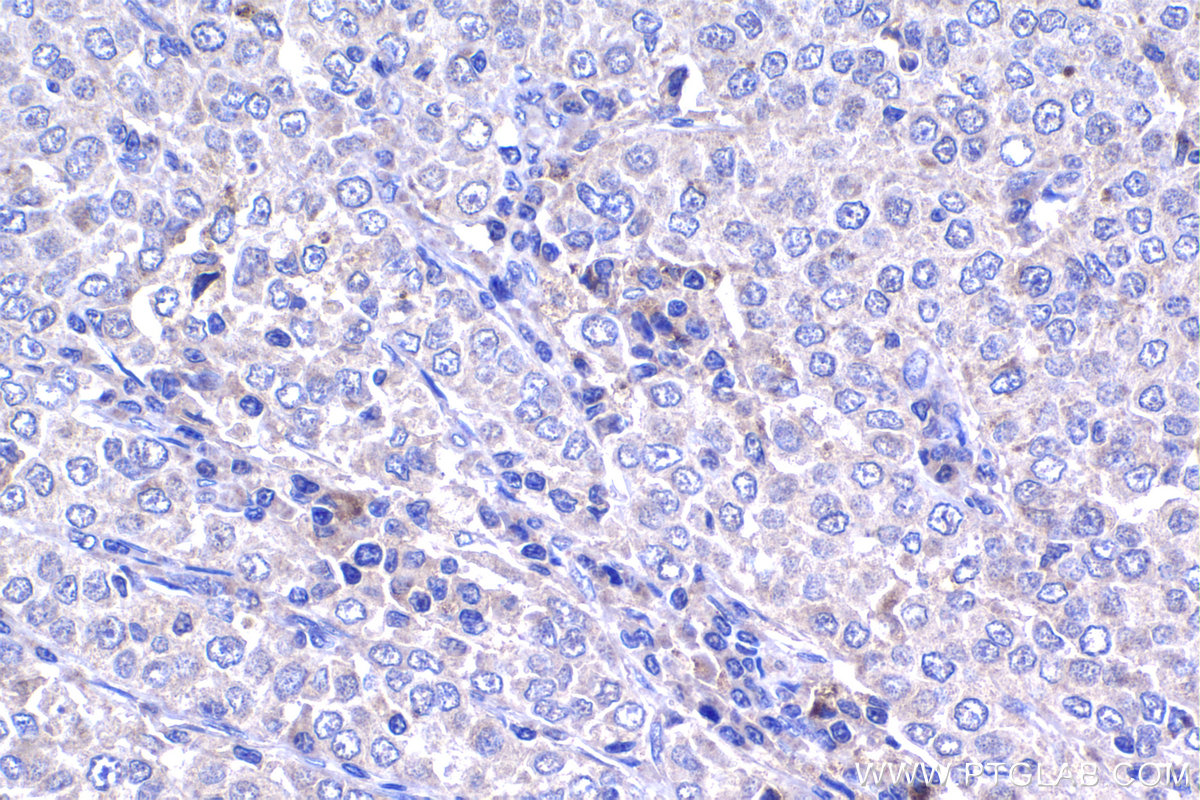 IHC staining of human ovary tumor using 20777-1-AP IHC staining of human ovary tumor using 20777-1-AP