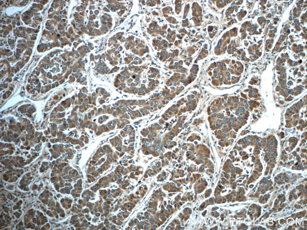 IHC staining of human liver cancer using 24529-1-AP