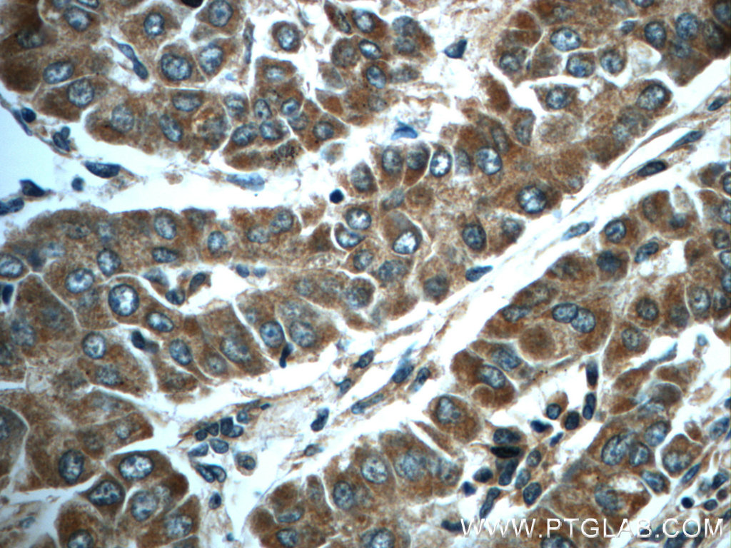 IHC staining of human liver cancer using 24529-1-AP