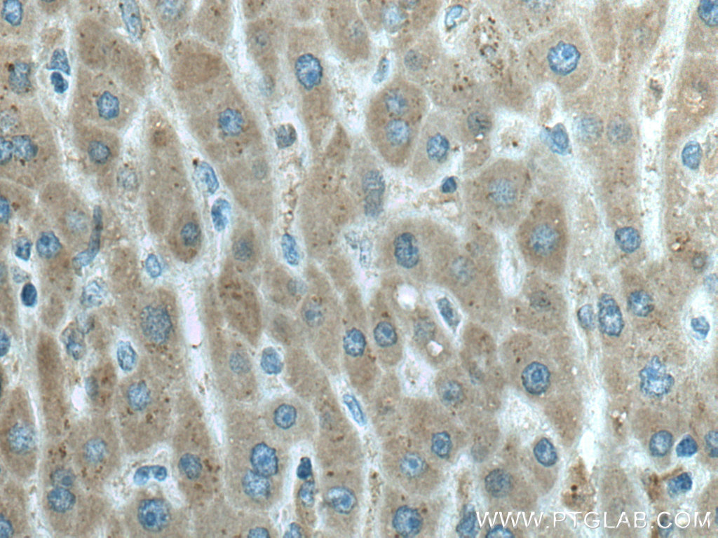 IHC staining of human liver cancer using 67488-1-Ig