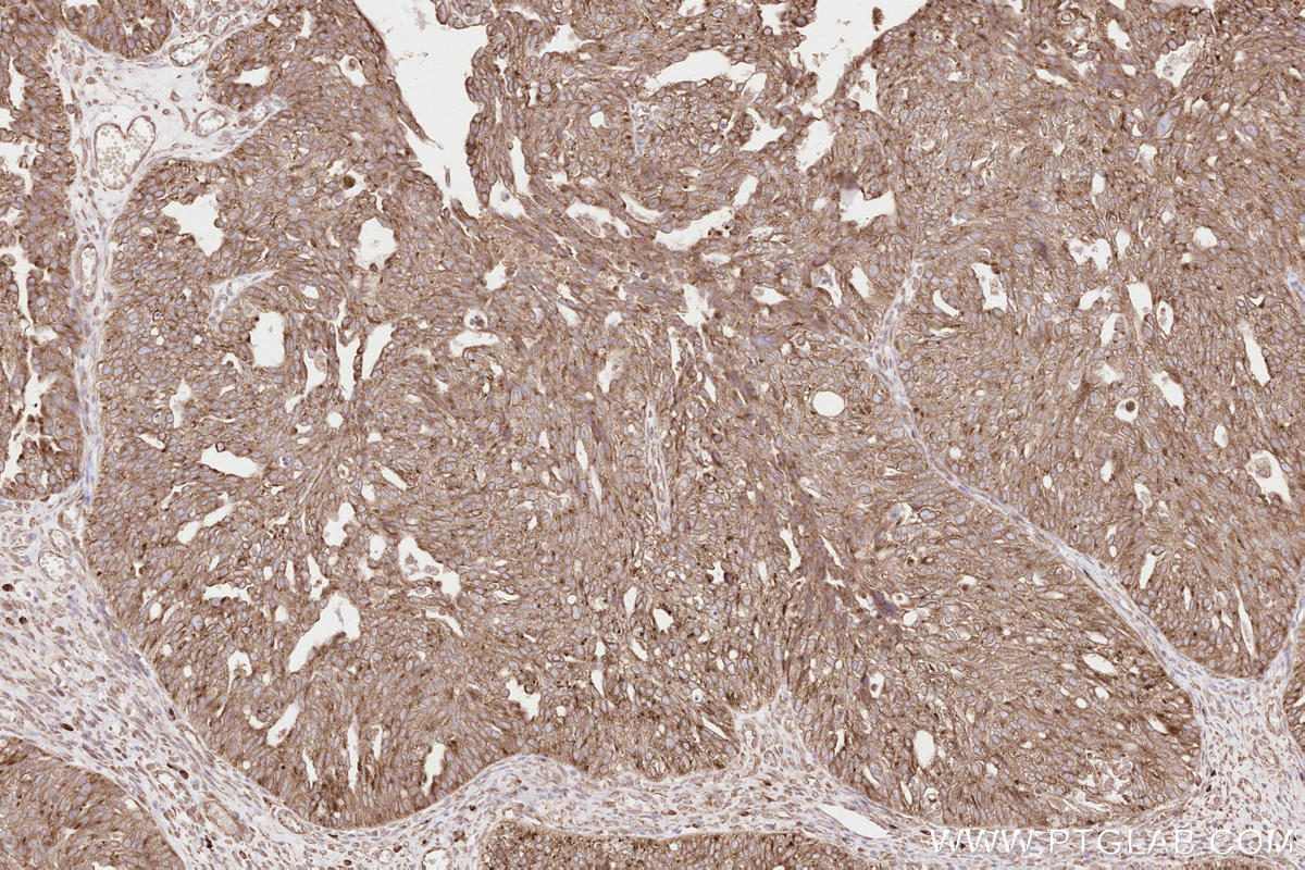 IHC staining of human ovary cancer using 67488-1-Ig
