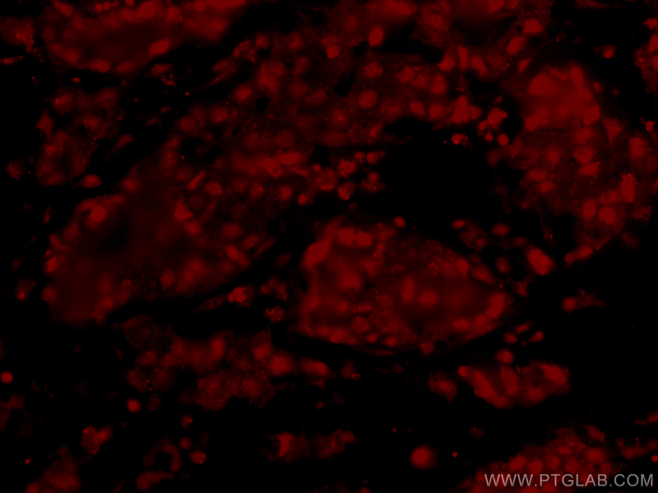 IF Staining of human breast cancer using CL594-66490